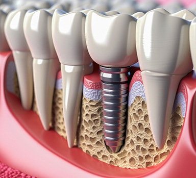 diagram of a dental implant fully integrated with the jawbone