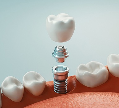 diagram of crown being put on a single dental implant