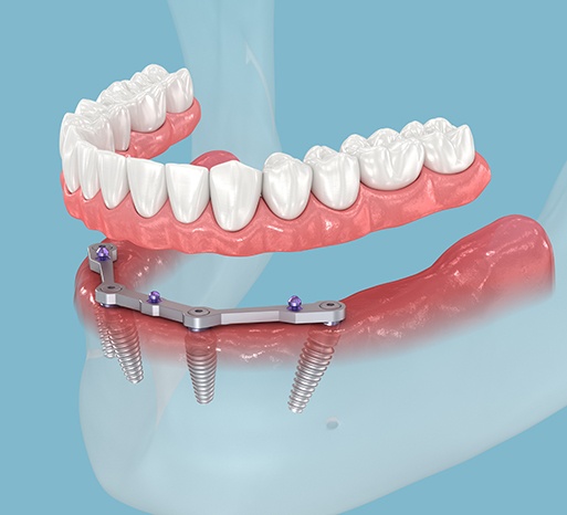 Illustration of dentures being attached to All-on-4 implants in Itasca, IL