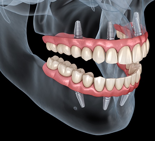 Illustration of dentures anchored to All-on-4 implants in upper and lower jaw