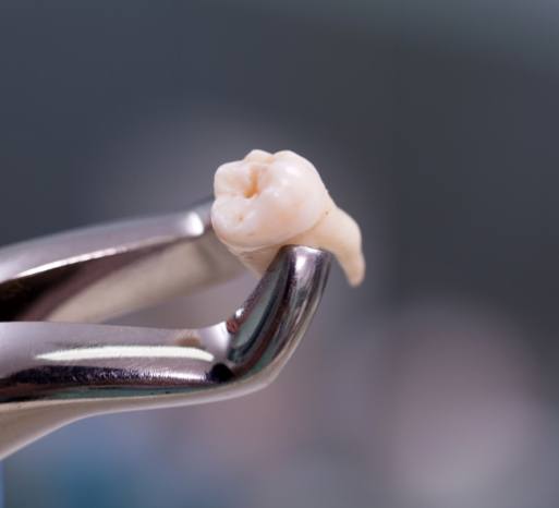 Metal clasp holding an extracted tooth