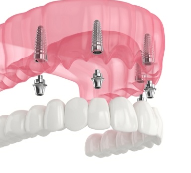 Animated smile with dental implant supported denture