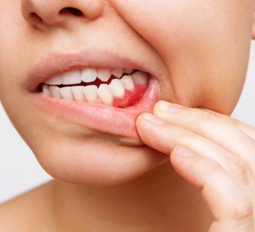 Closeup of damaged smile before gum disease treatment