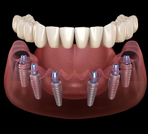 Illustration of an implant denture
