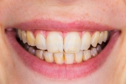 Closeup of smile with stained teeth