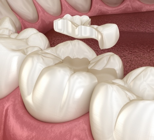 Animated smile during porcelain dental inlay placement