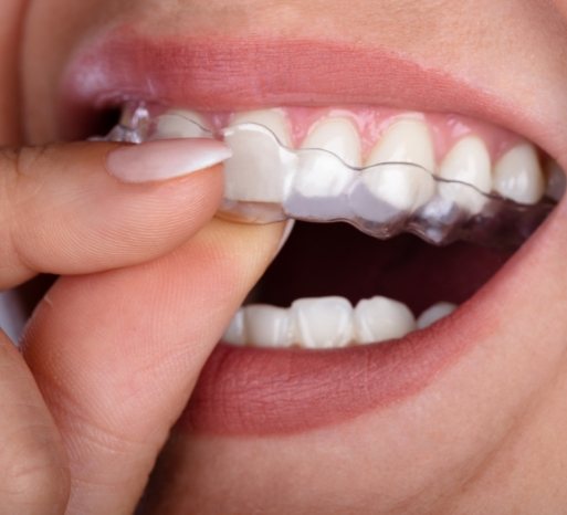 Closeup of dental patient placing an Invisalign tray