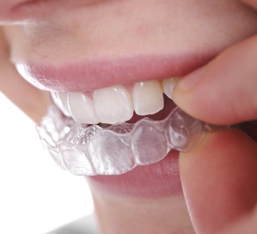 Closeup of dental patient placing Invisalign clear aligners