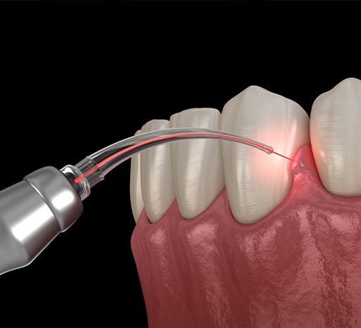 Animated smile during laser bacterial reduction