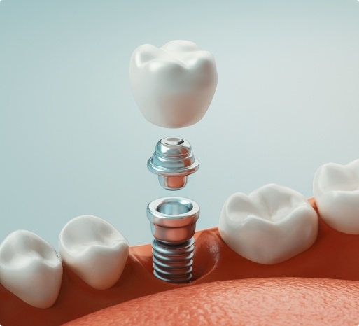 Animated smile during dental implant supported dental crown placement