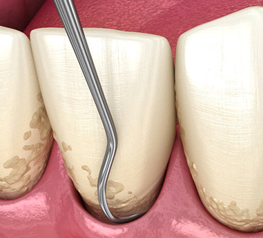 illustration of scaling and root planing in Itasca, IL
