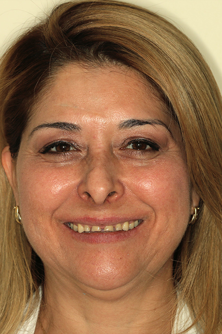 Smile with damaged and worn teeth before cosmetic dentistry