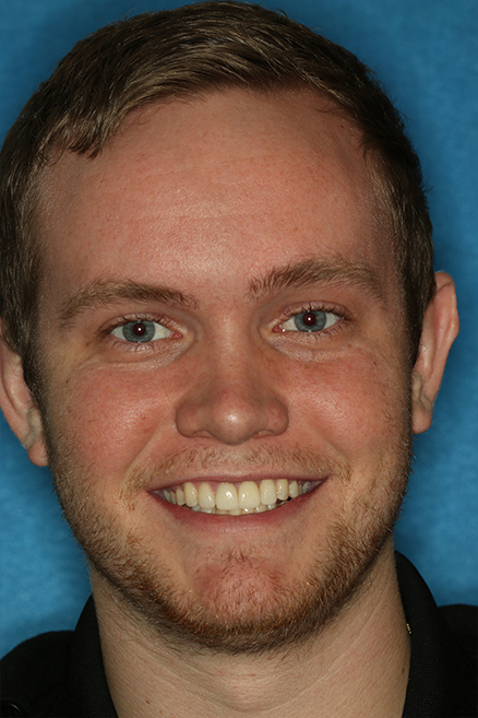 Smiling young man after top pront tooth and gums were repaired