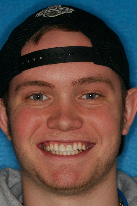 Young man with damaged top front tooth and gums