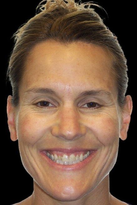 Discolored and imperfect smile before cosmetic dentistry