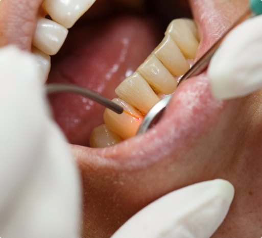 Dental patient receiving soft tissue laser dentistry treatment