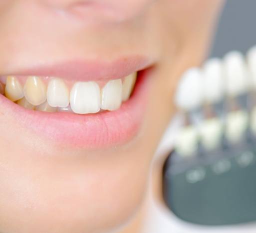 Closeup of smile after in office teeth bleaching