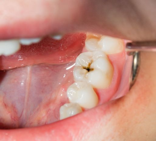Closeup of smile with tooth decay